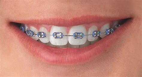 azul metalico brackets|colores de brackets dentales.